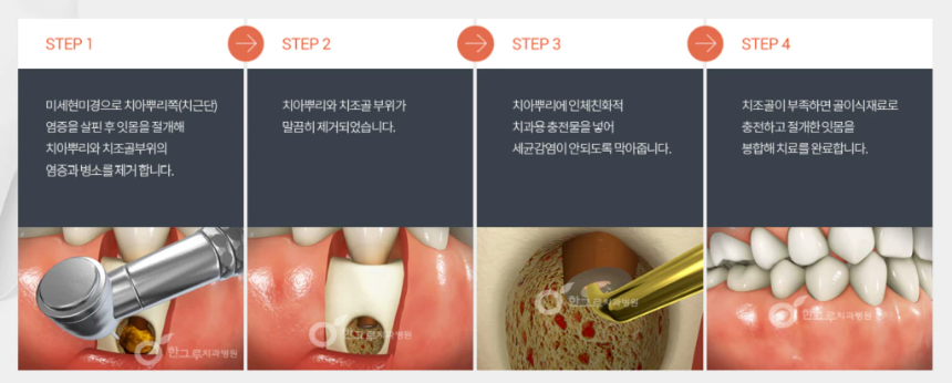 치근단-절제술-수술-과정