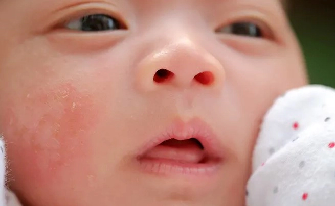 신생아 뾰루지 증상