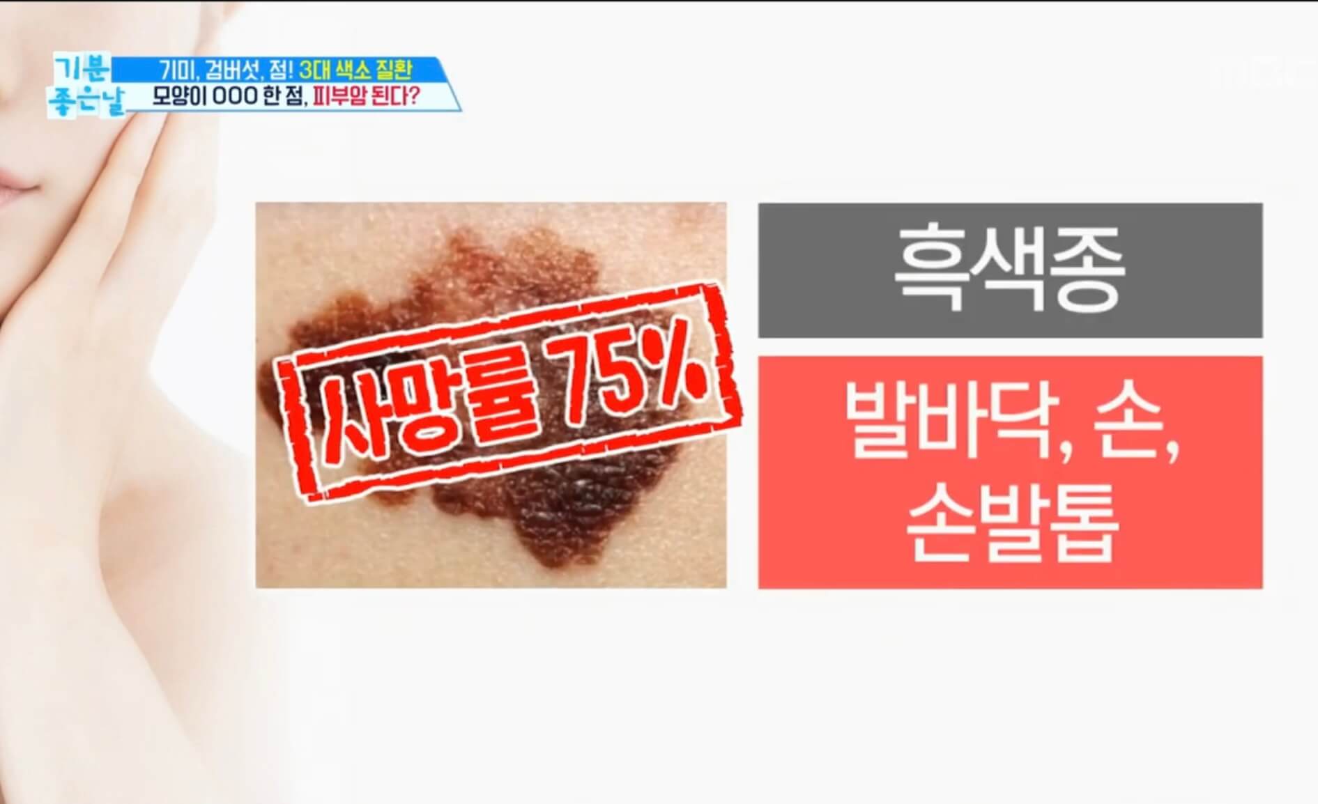 피부암