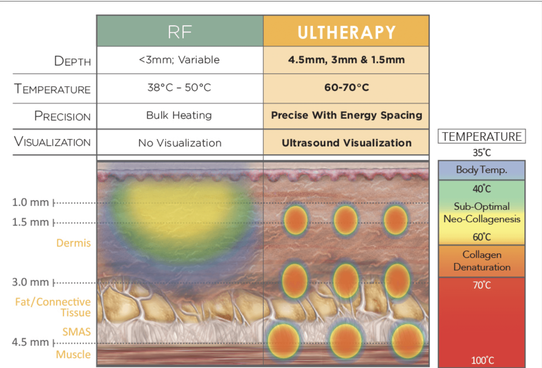 피부과리프팅레이저 시술 고민이라면? 고주파(RF) 리프팅 시술 비교 