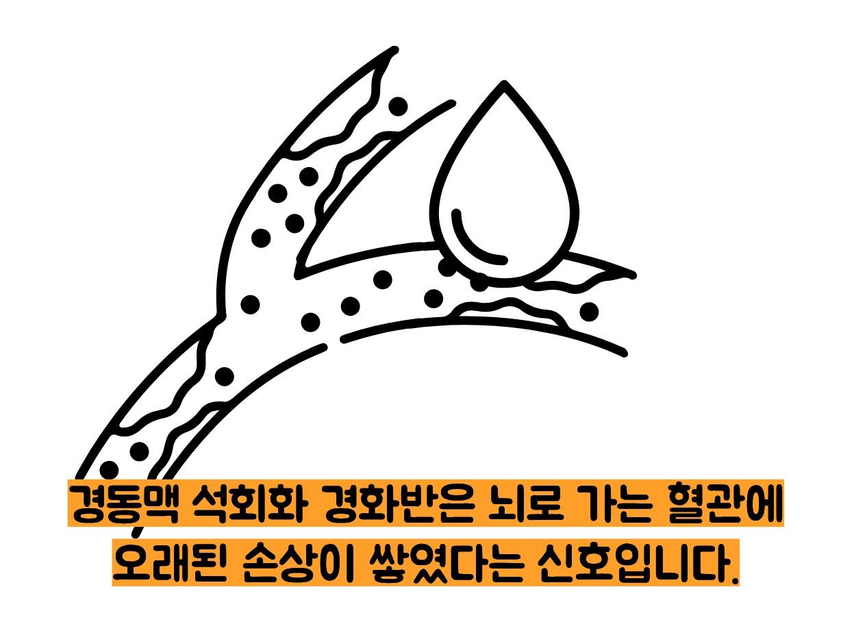 경동맥 석회화 경화반