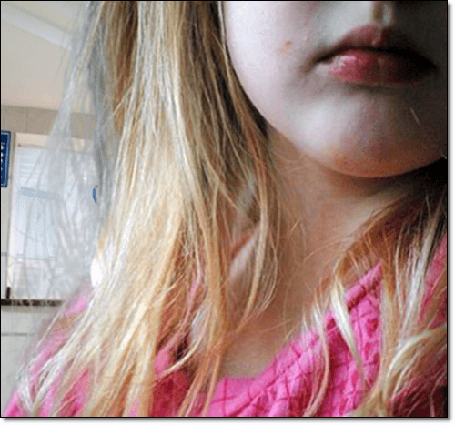 구순포진 어린이