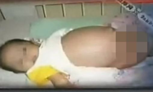 중국 태아속 태아