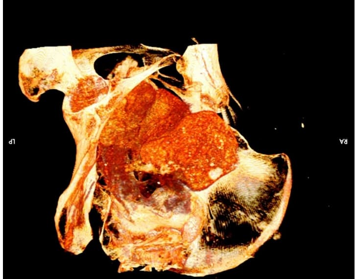 세계 최초 임신 미이라 공개 VIDEO: A Closer Look at the World's First Pregnant Egyptian Mummy