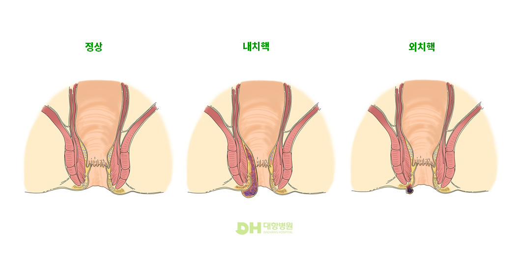 치질 증상&middot;원인&middot;치료!