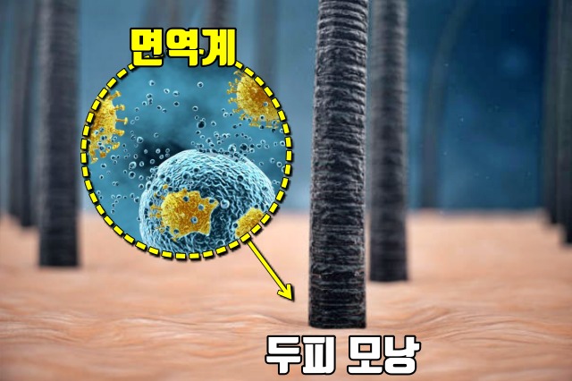 심한 스트레스 증상, 탈모, 원형탈모, 두피 모낭염 건강 팁줌 매일꿀정보