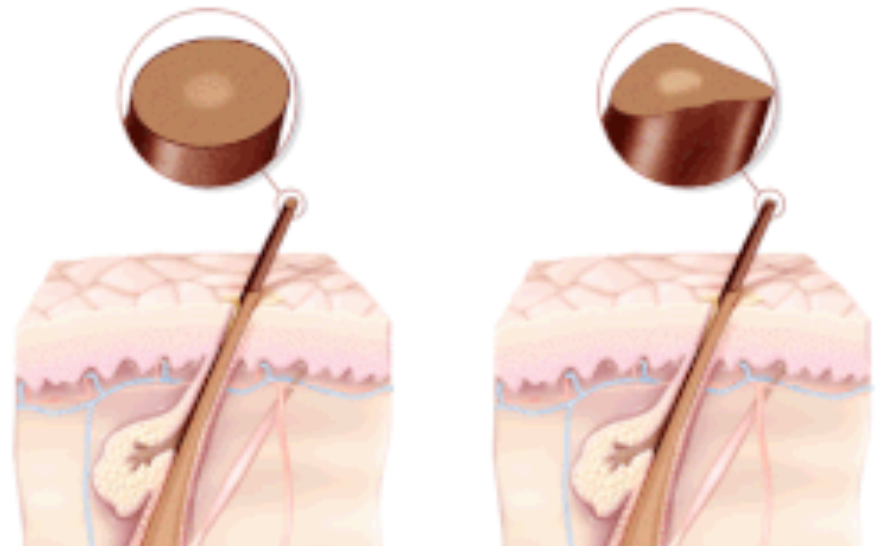 양모모발증후군 뜻 증상 원인 선천성 유전 양털모발증후군 총정리2