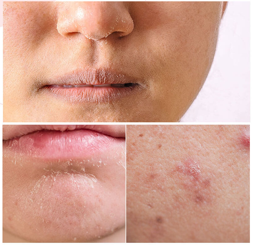 닥터윈트 레드 바하겔 &amp;#44;마스크 벗은 후 내 피부는