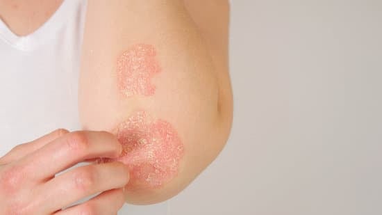 습진 (Eczema)의 유형과 치료