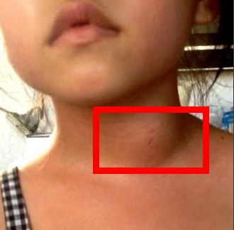 담배로인해목에림프종초기단계사진