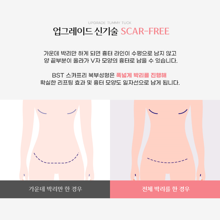 BST 스카프리 복부성형은 폭넓게 박리를 진행해 확실한 리프팅 효과 및 흉터 모양도 일자선으로만 남게됩니다.