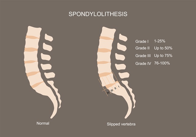 요추 전방전위증
