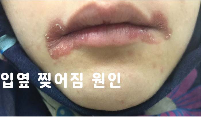 입옆 찢어짐 이미지 입니다.