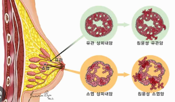 유방암 원인부터 진단 검사까지: CA15-3 · CEA · TPA 검사