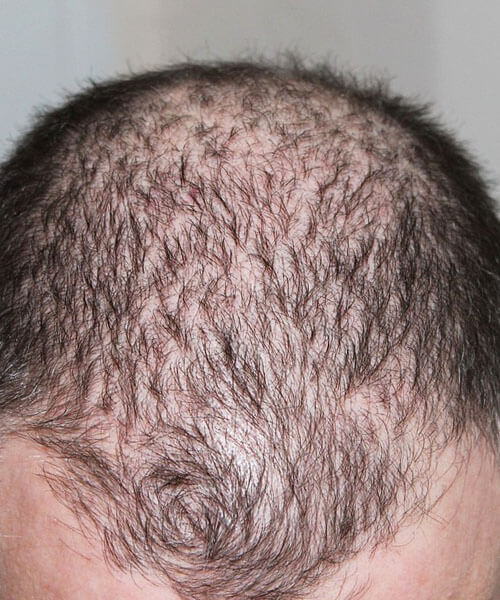 탈모-발생-머리