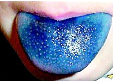 혓바늘이 돋는 이유 알아보기