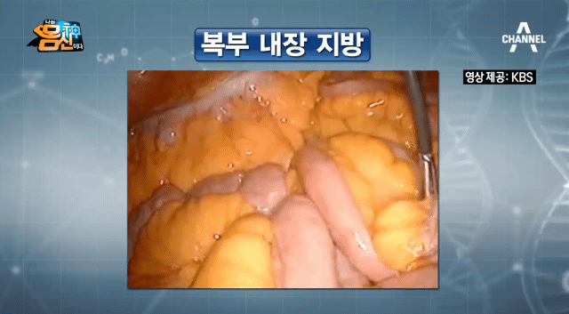 복부 내장지방