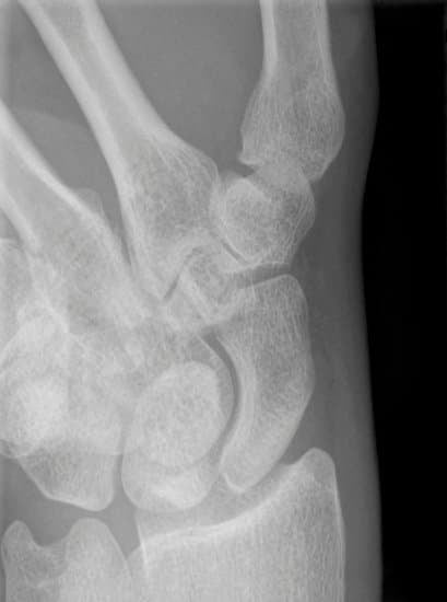 주상골 불유합(Scaphoid Nonunion): 원인, 증상 및 치료 방법
