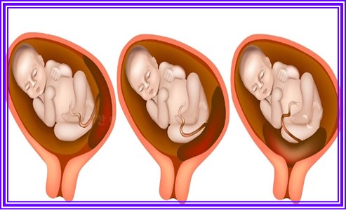 임신 중 체중 증가 9가지
