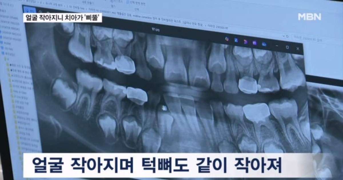 작아지는 아이들 얼굴, 치아 건강에 치명적