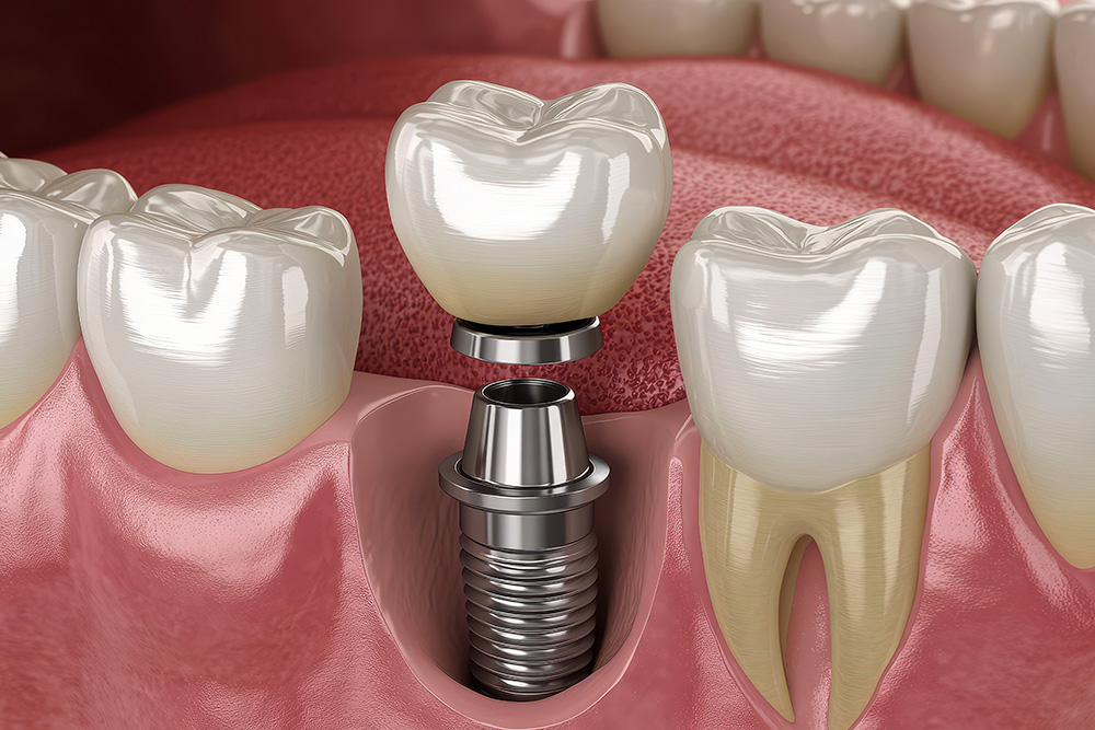 임플란트의 의료보험 보장 범위