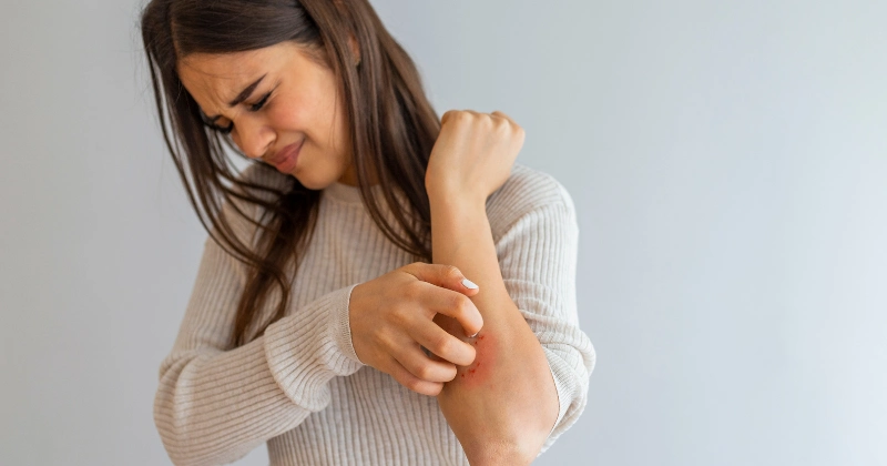 지루성피부염 때문에 간지러워하는 여성