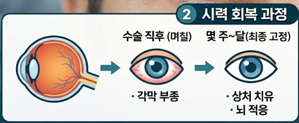 백내장 수술후 시력회복 기간