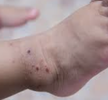 고지혈증 증상 11