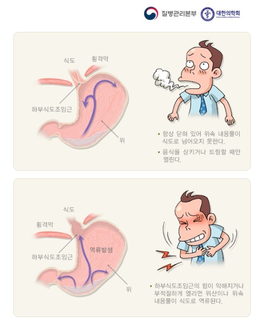 역류성 식도염 스트레스가 증상을 악화시키는 이유