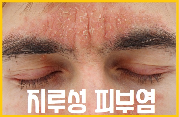 지루성 피부염