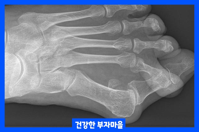 증상 - 엑스레이 촬영