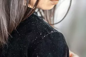 두피 지루성 피부염