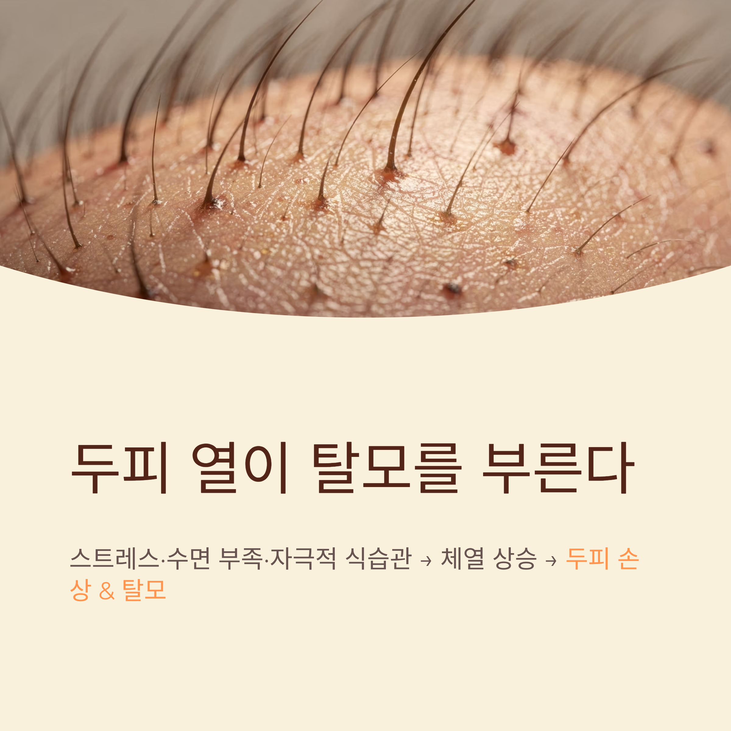 두피 열