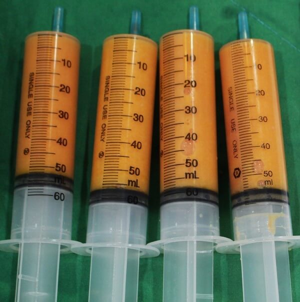 지방분해주사 지방흡입주사 효과 장점 부작용