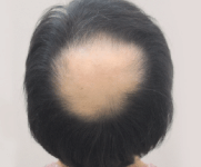 탈모의 원인과 해결방안