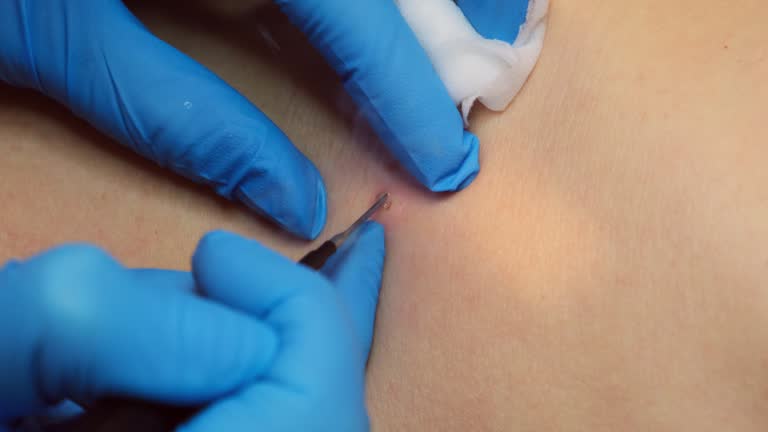 피지낭종 수술, 꼭 해야 하나요? 원인부터 흉터 없는 회복까지