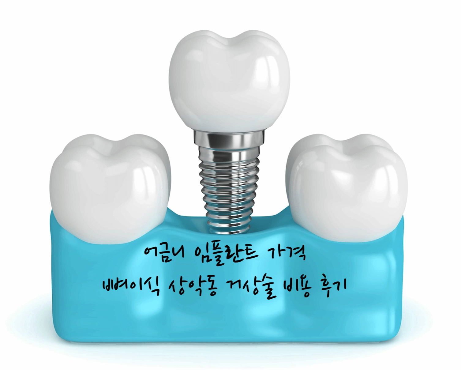 어금니 임플란트