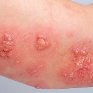 대상포진 초기증상