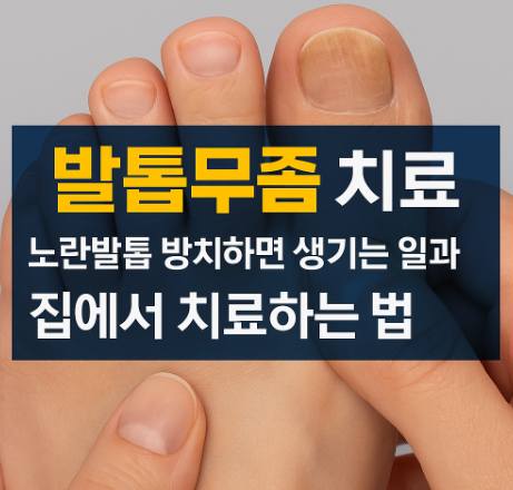 발톱무좀치료