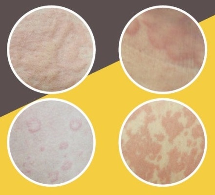 만성두드러기의 형태