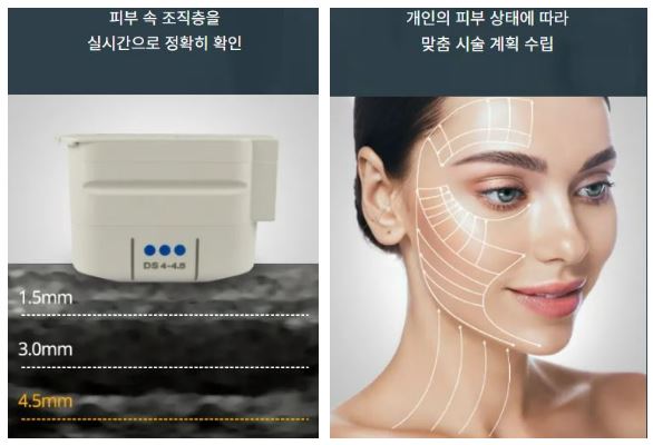 울쎄라 효과 효능