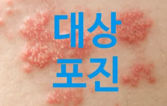 경기도 대상포진 무료접종 연령 기준 정리로 안내_16