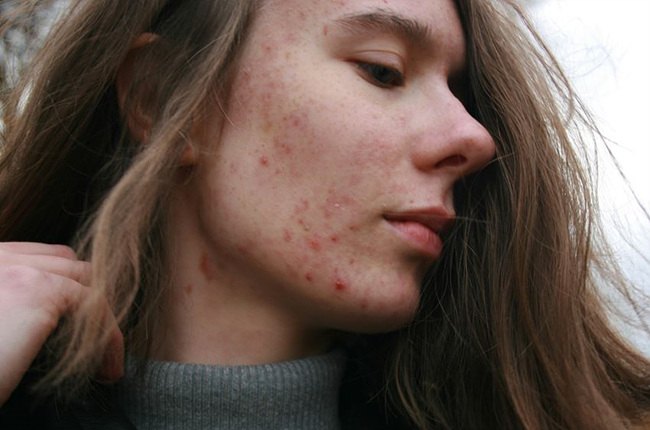 여드름 피부,unsplash 제공