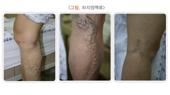 하지정맥류, 판막부전, 다리부종, 정맥류치료,