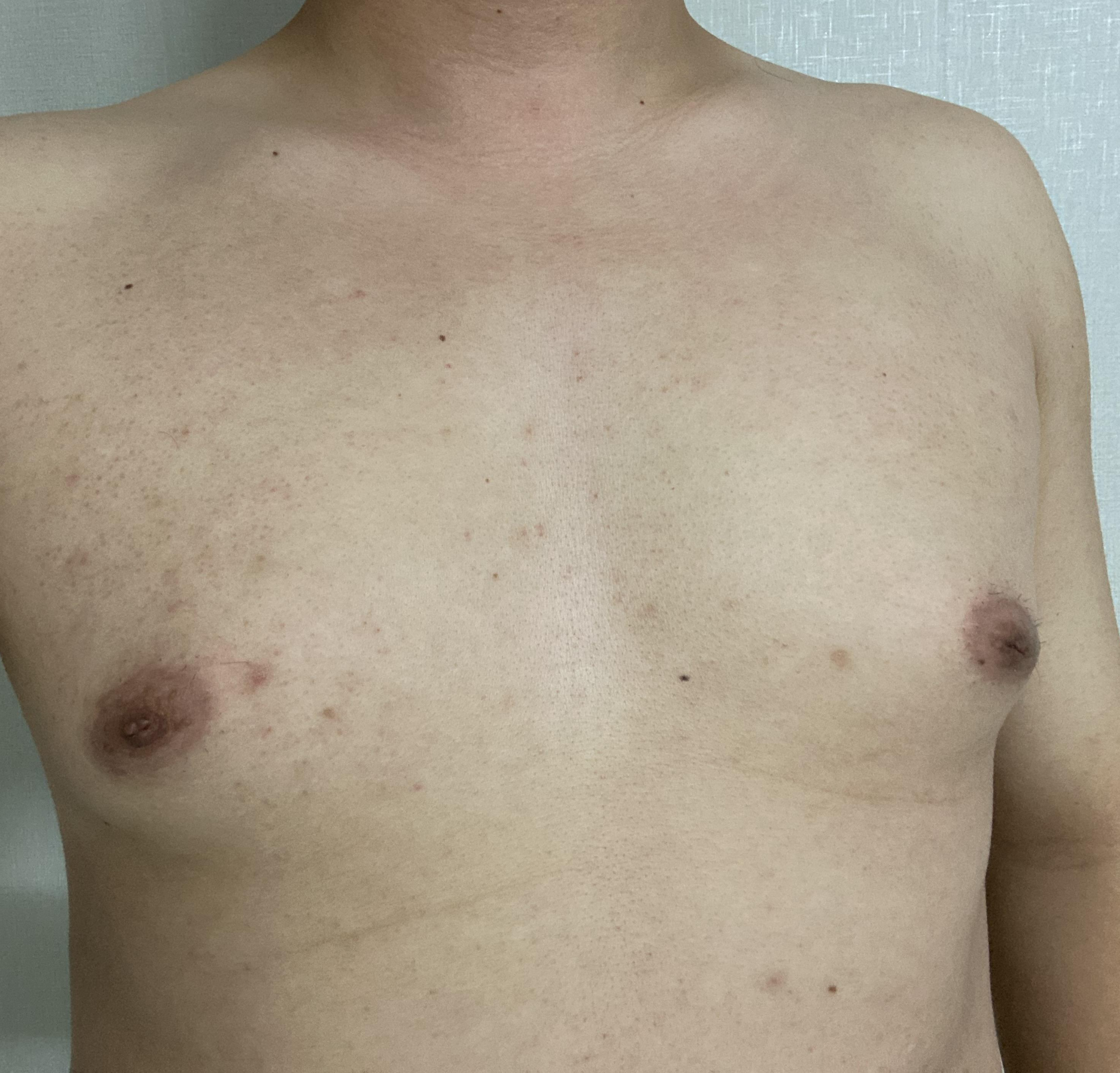 여유증 수술 전 사진 앞 모습