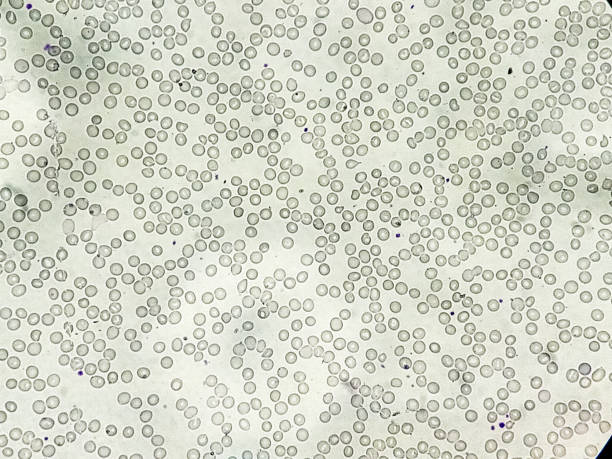 혈소판 수치 올리는 방법