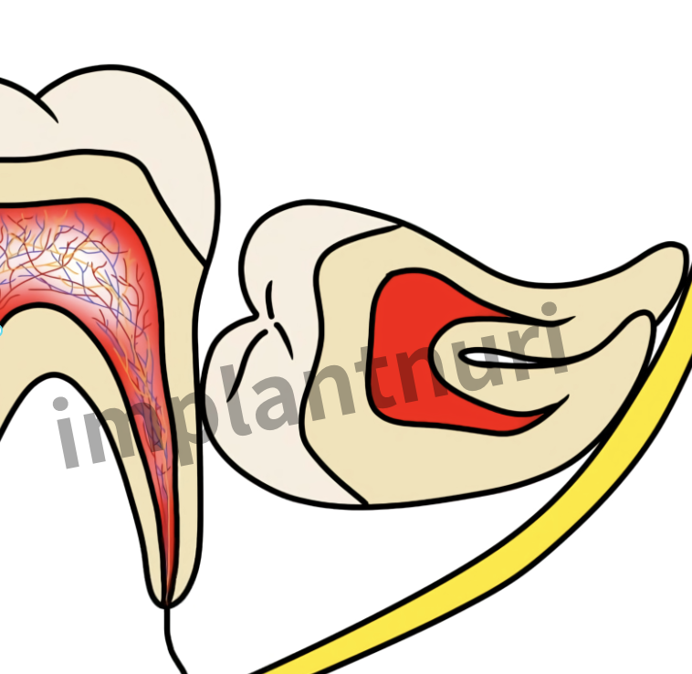 사랑니 발치 후 실밥 제거 늦어도 괜찮나요