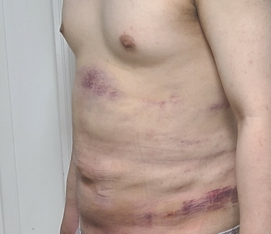 복부지방흡입 후기