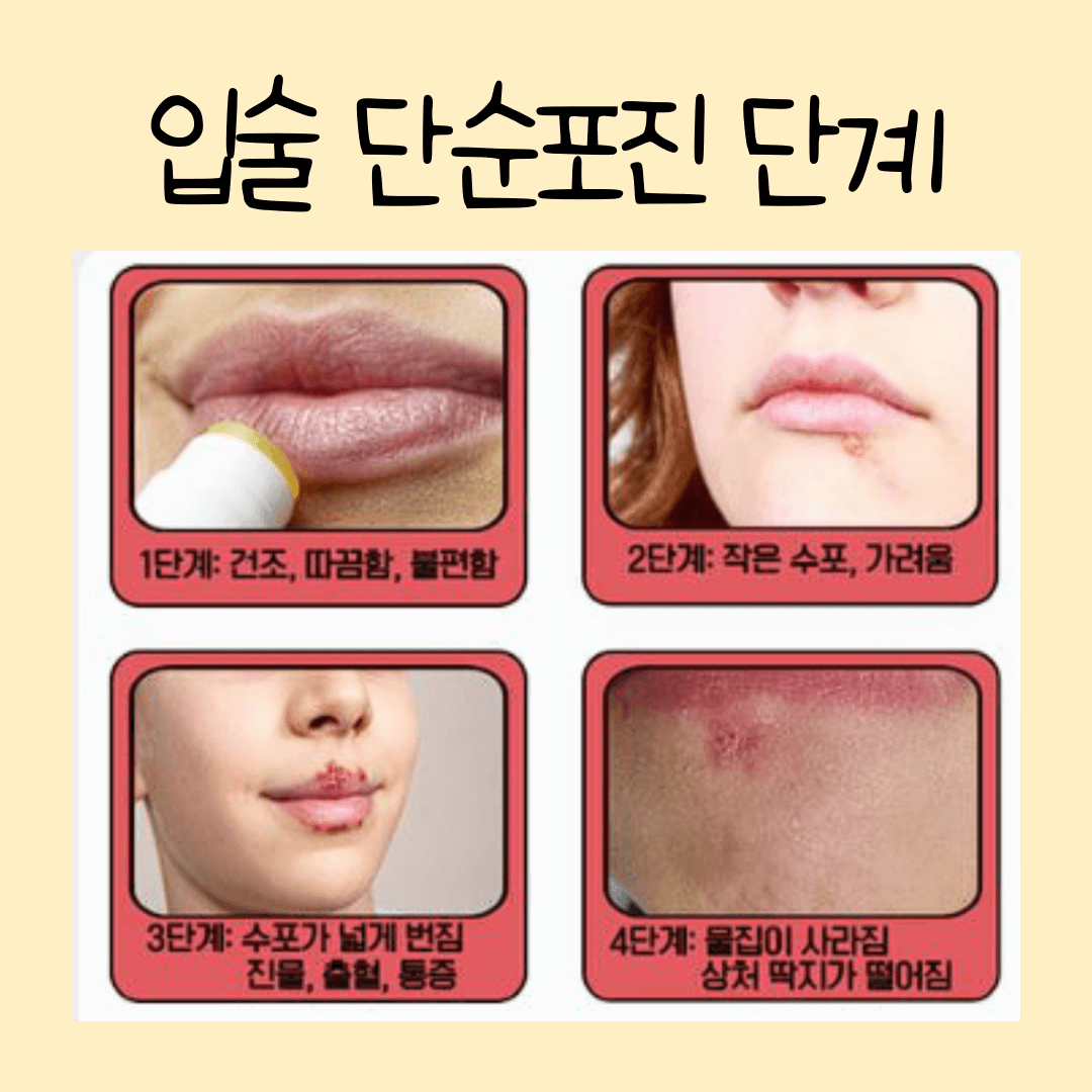 단순포진
