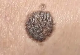 검버섯